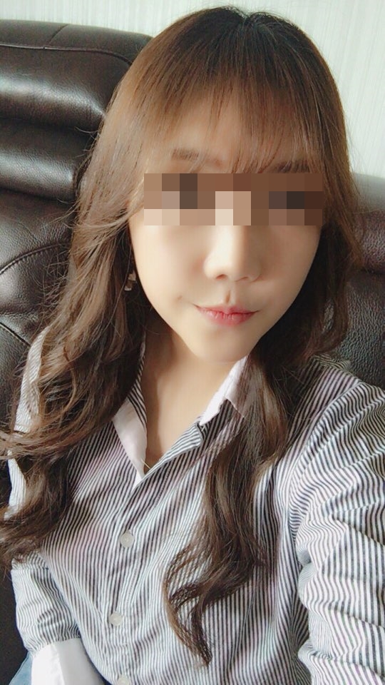 비대칭 턱(양악) +안면윤곽 7개월차