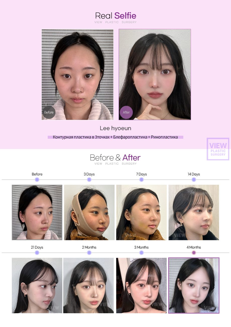 [Контурная пластика в 3точках+Блефаропластика+Ринопластика]