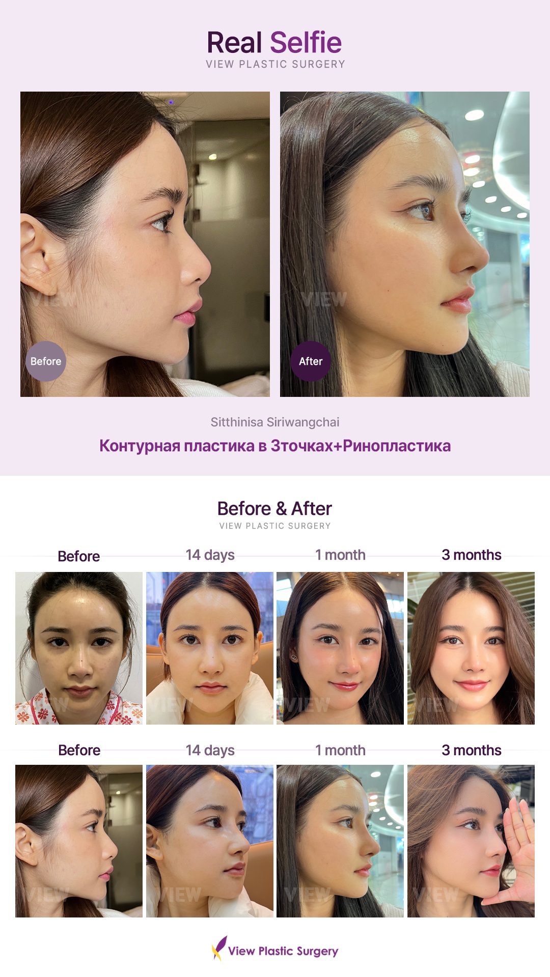 Контурная пластика в 3точках + Ринопластика