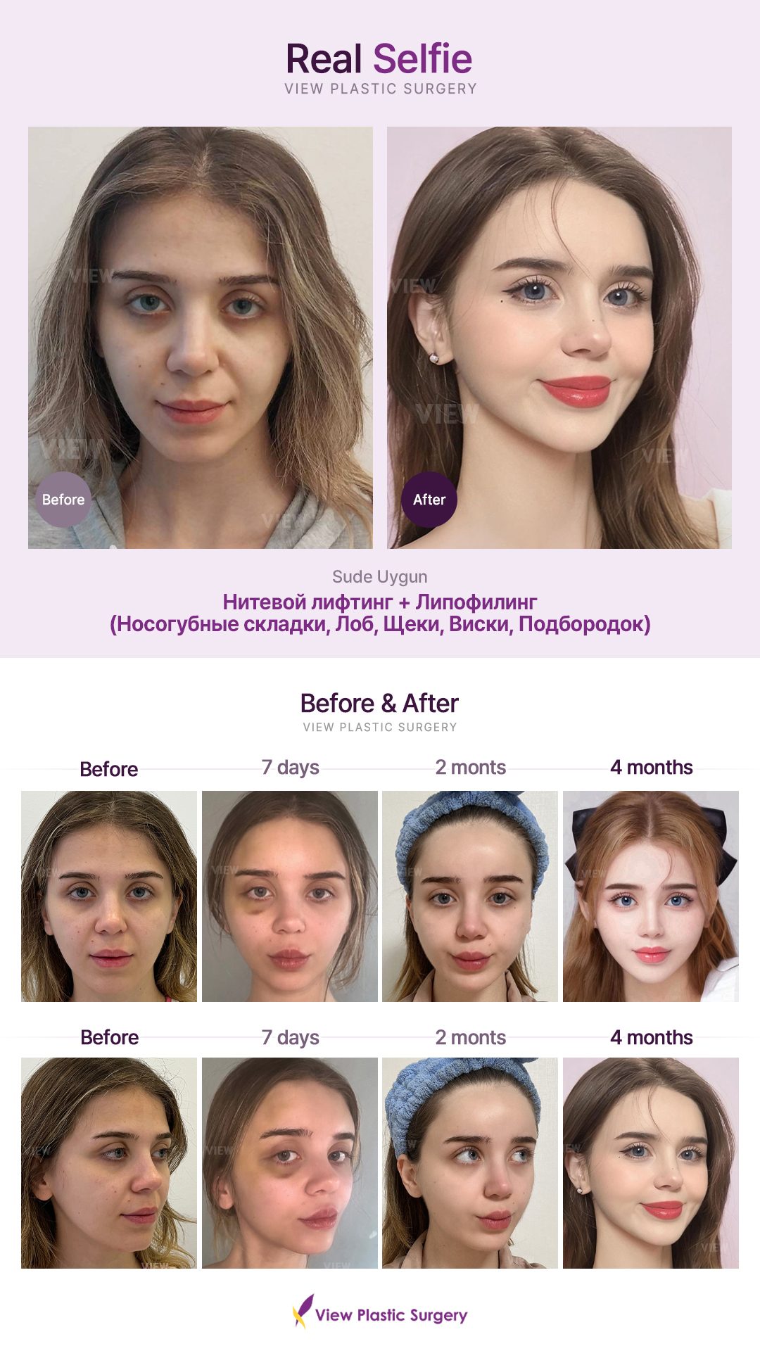 Нитевой лифтинг + Липофилинг (Носогубные складки, Лоб, Щеки, Виски, Подбородок)