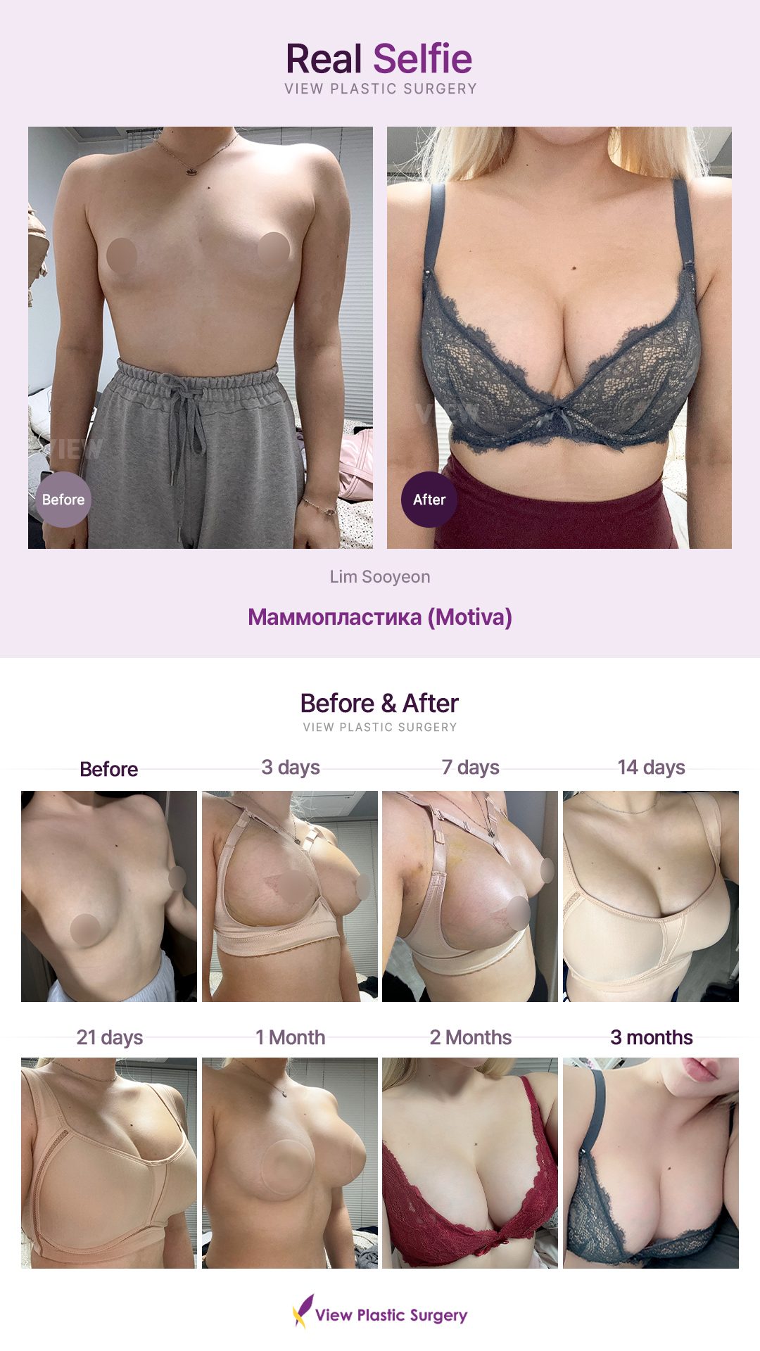 Маммопластика (Motiva)