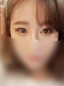 [Wrinkle double eyelids (eyelid correction surgery) + slit in the front + slit in the back + slit in the bottom] Hyeran Park