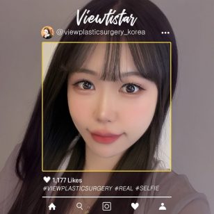 [Повторная блефаропластика + Эпикантопластика] So yuna | Plastic Surgery Korea