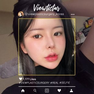 [Блефаропластика+Ринопластика+Липофилинг лица+Липосакция лица] Kang Yooseon | Plastic Surgery Korea