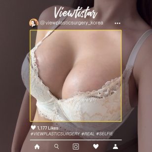 [Маммопластика (Motiva)] Lee Yumi | Plastic Surgery Korea