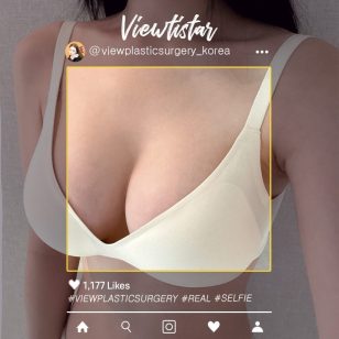 [Маммопластика (Mentor Boost)] Gu Dohee | Plastic Surgery Korea