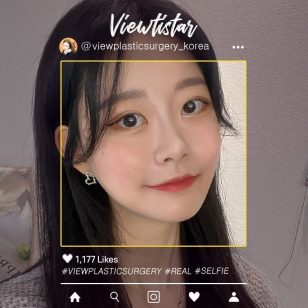 [Контурная пластика, Блефаропластика, Нитевой лифтинг] Wang Jungsuan | Plastic Surgery Korea