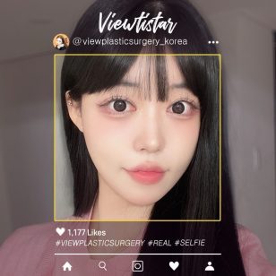 [Блефаропластика+Нитевой лифтинг+Липосакция лица+Липофилинг] Park Sehee | Plastic Surgery Korea