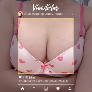 [Увеличение груди (Mentor boost)] Jeon Soyeon | Plastic Surgery Korea