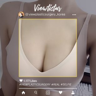 [Увеличение груди (Mentor Xtra)] Kim hawon | Plastic Surgery Korea